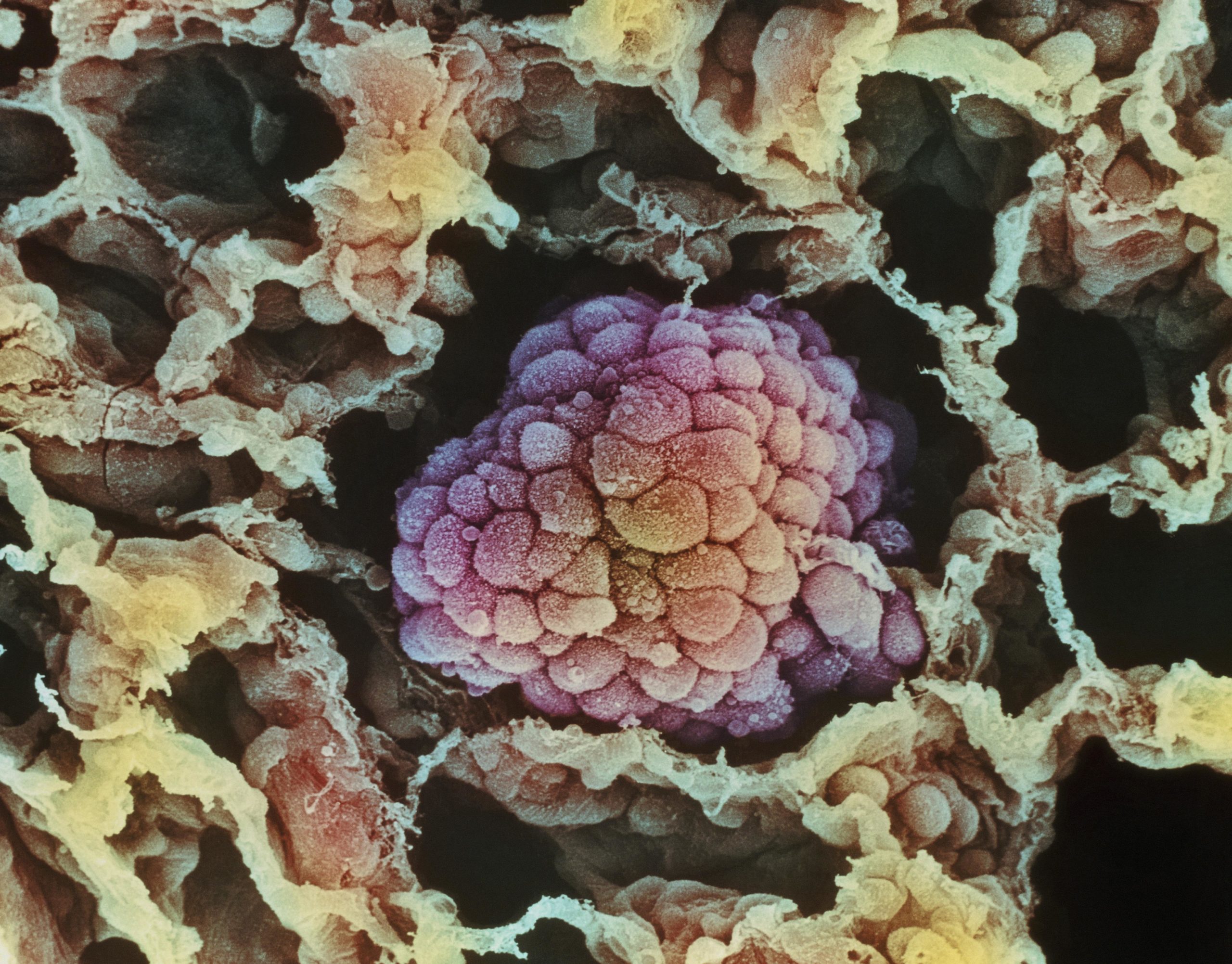 Что такое онкология. Раковые клетки микрофотографии. Злокачественная опухоль. Раковая клетка подтмикроскопом. Опухолевые клетки под микроскопом.