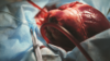 cardiac transplant
