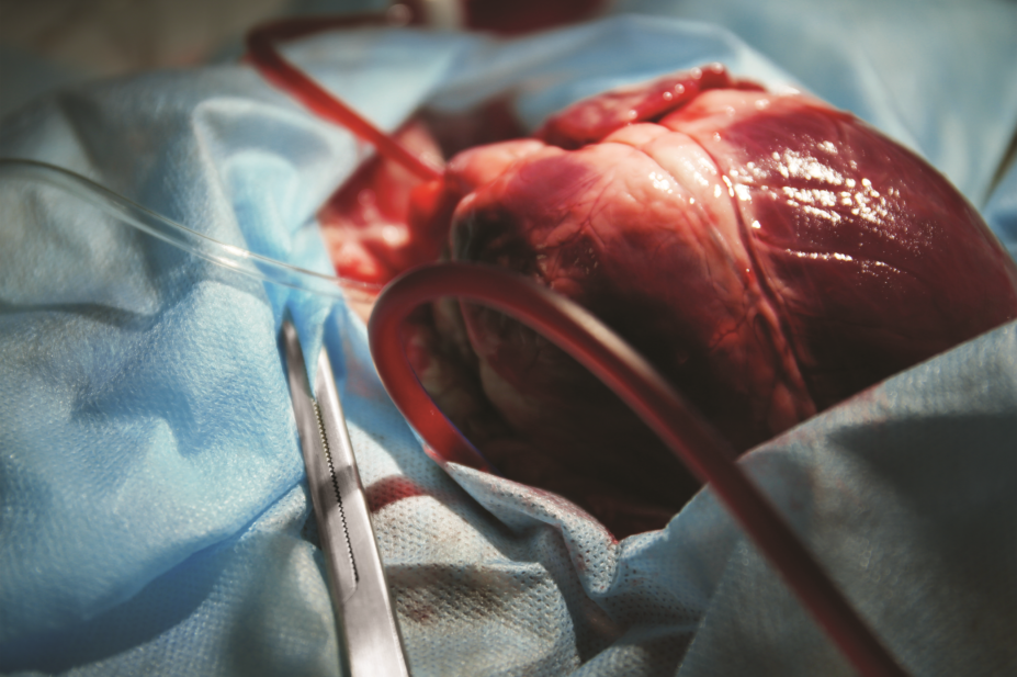 cardiac transplant