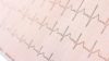 Electrocardiogram trace