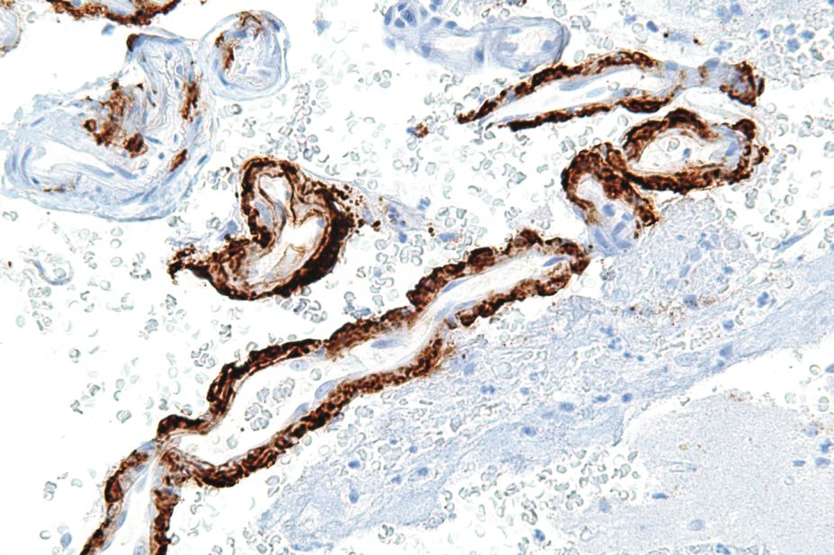 Alzheimer’s disease is characterised by the pathological accumulation of amyloid beta (Aβ) (pictured) and tau proteins, which are highly toxic and cause synaptic and mitochondrial dysfunction.
