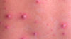 Chickenpox rash close up