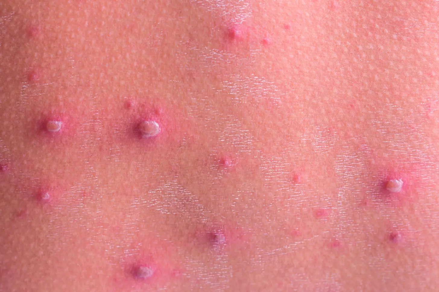 rashes-in-children-the-pharmaceutical-journal