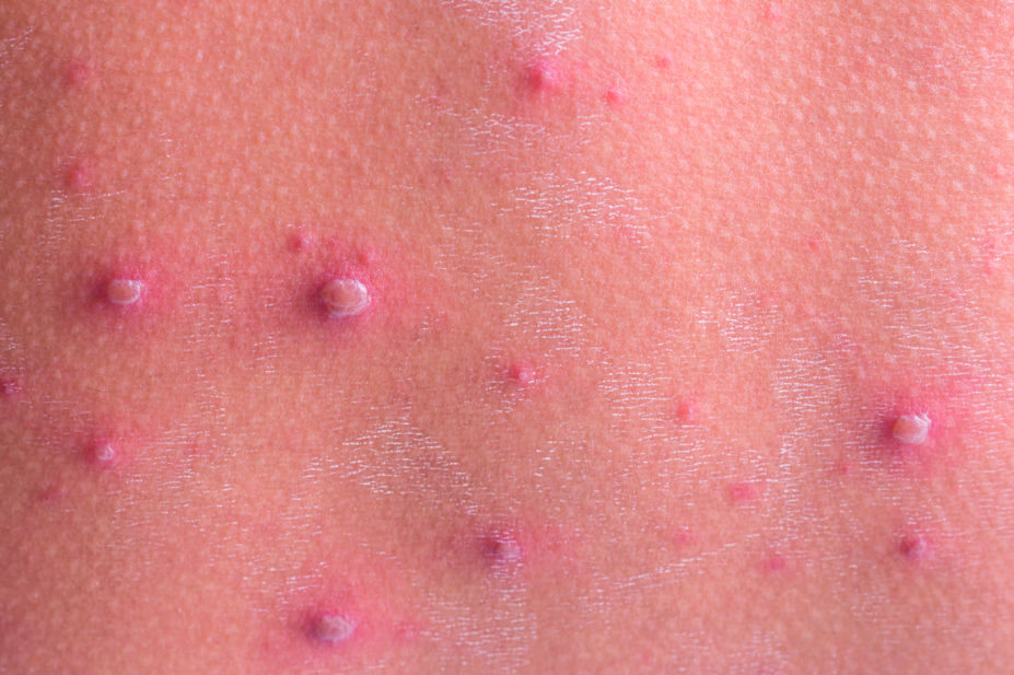 Chickenpox rash close up