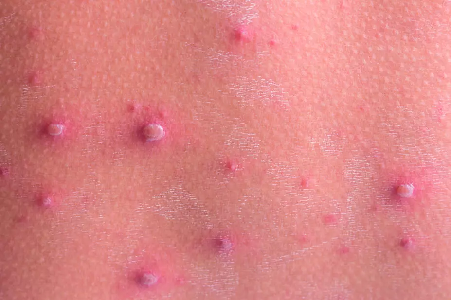 Chickenpox rash close up