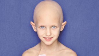 Close-up of a young girl with cancer who received chemotherapy treatment