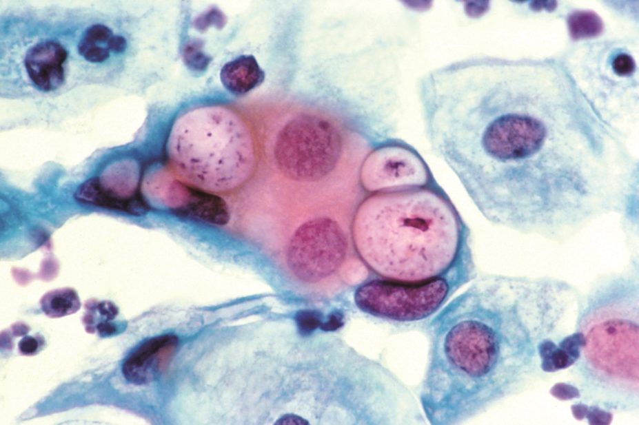 Study finds that azithromycin is not as clinically effective as doxycycline for chlamydia. In the image, human pap smear showing chlamydia