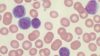 High-power magnification of a Wright's stained peripheral blood smear showing chronic lymphocytic leukemia (CLL)
