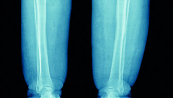 Xray showing chronic oedema in the lower limb