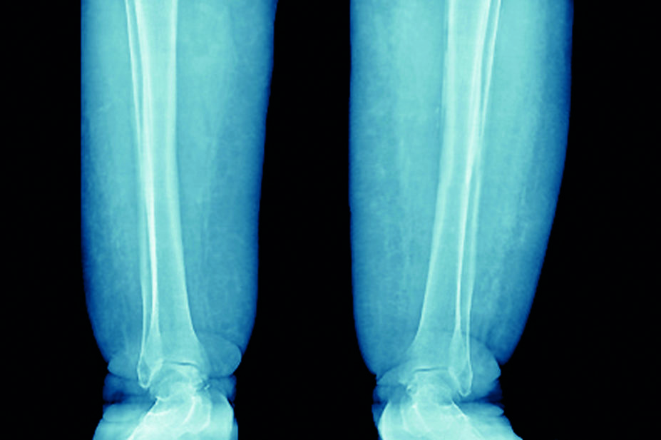 Xray showing chronic oedema in the lower limb
