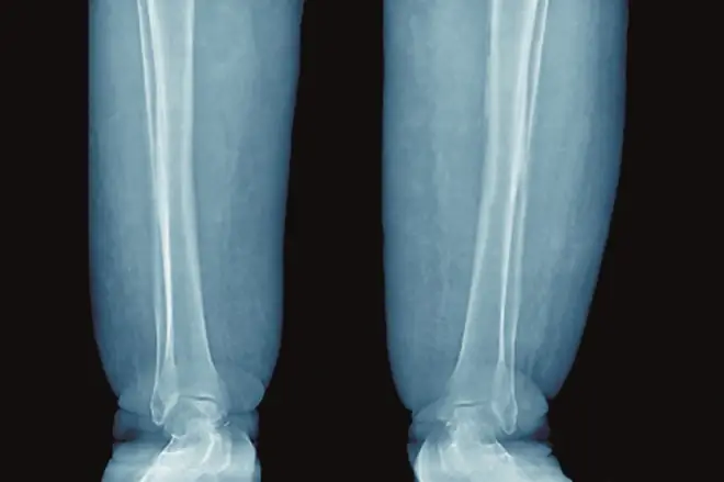 Image of "Coloured X-ray (front view) of the lower limbs of a female patient showing oedema with deformation of the ankle joint."