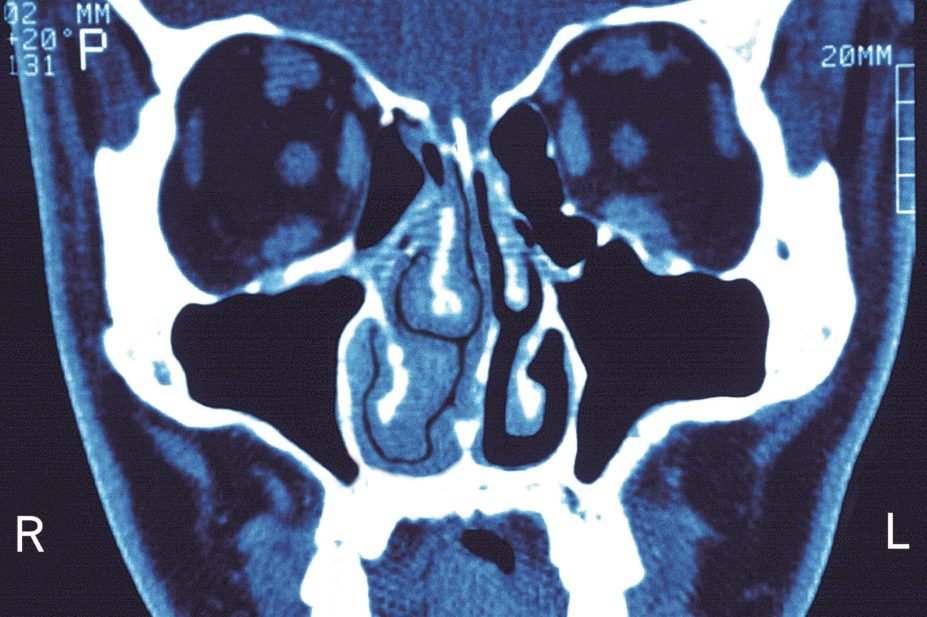 MRI scan of sinusitis in the middle nasal concha, and right inferior nasal concha