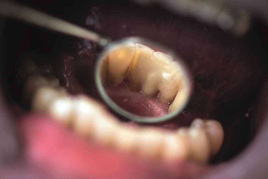 Close up of teeth during a dental examination