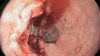 Colon cancer endoscope image