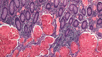 Colon cancer micrograph