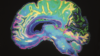 Coloured brain scan