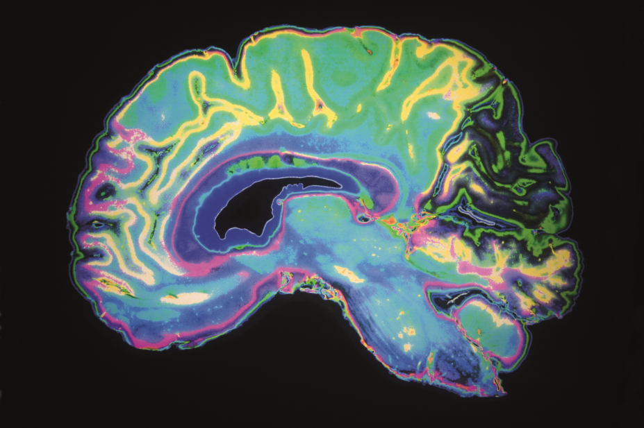 Coloured brain scan