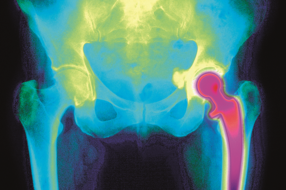 Coloured x-ray of a hip replacement