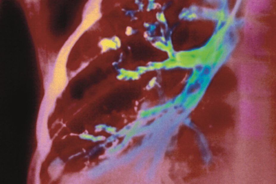 Research shows that cystic fibrosis drug ivacaftor is well tolerated but needs close monitoring in patients aged 2-5 years. In the image, coloured x-ray of a lung with cystic fibrosis