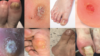 Images of common foot conditions