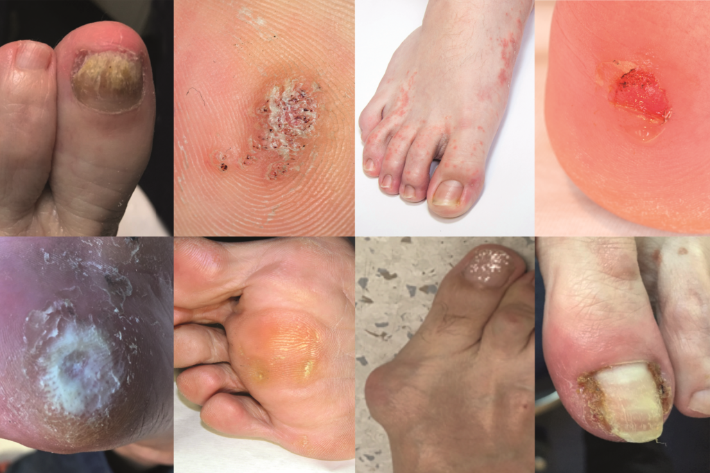 Sally's Foot Clinic - Athlete's foot (tinea pedis) is a fungal