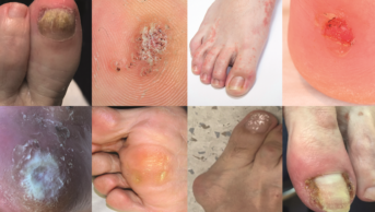 Images of common foot conditions