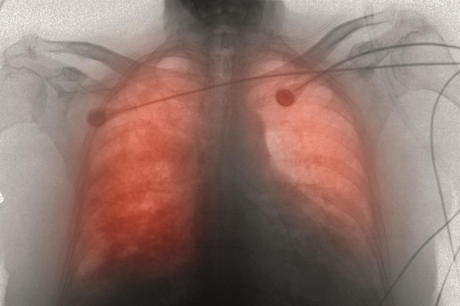 An x-ray of congestive heart failure