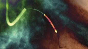 Coloured X-ray angiogram of a balloon catheter and stent (brown, upper centre) being placed within a coronary artery of a heart