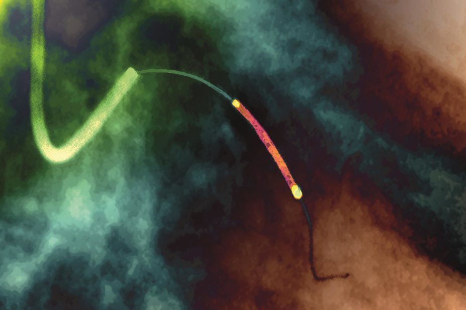 Coloured X-ray angiogram of a balloon catheter and stent (brown, upper centre) being placed within a coronary artery of a heart