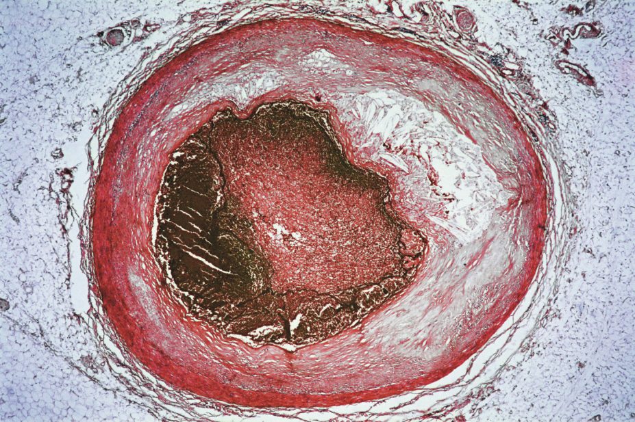Micrograph showing a coronary artery with atherosclerosis and thrombosis