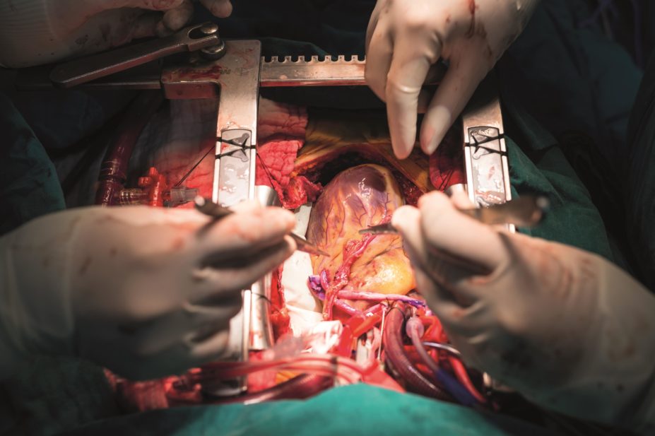 Evidence suggests that taking statins before and after coronary artery bypass grafting (CABG), operation pictured, can reduce postoperative inflammation