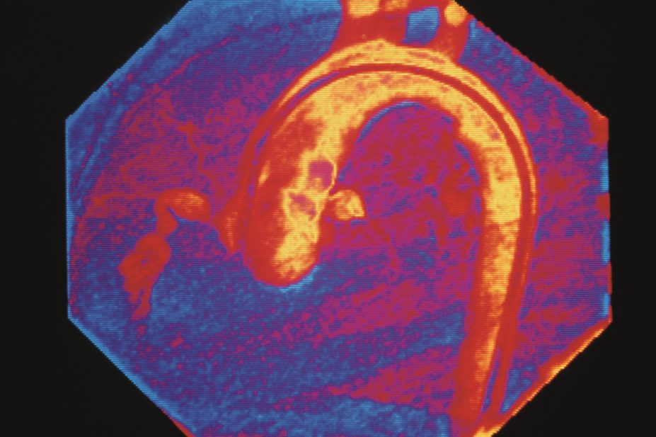 In the image, a colour x-ray of a coronary artery with Kawasaki disease, a type of vasculitis. Vasculitis is a collection of rare diseases characterised by the inflammation of blood vessel walls.