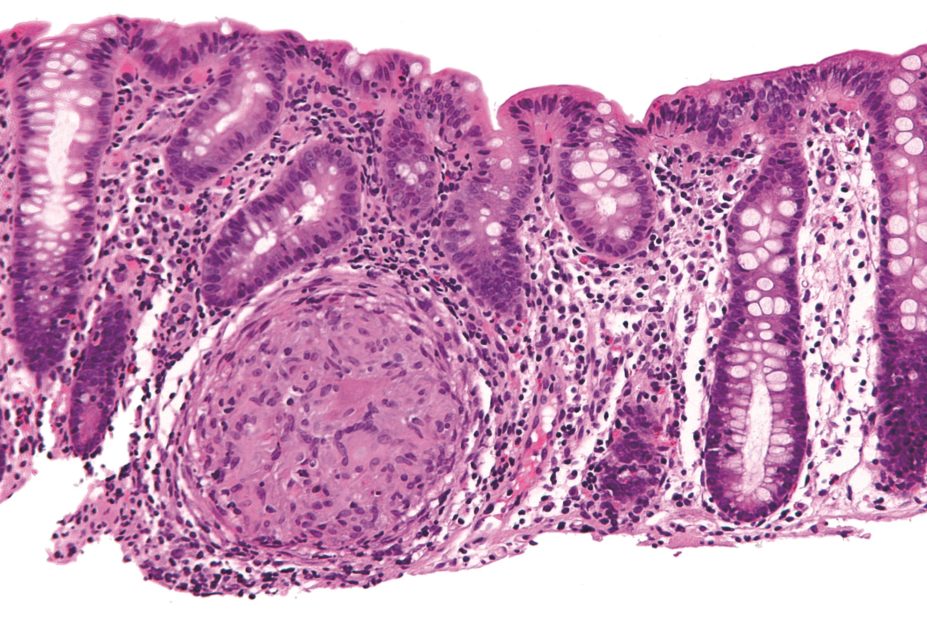 Researchers have developed a hydrogel that selectively delivers drugs to inflamed tissue, which could pave the way for improved treatment options for patients with inflammatory bowel disease (IBD). In the image, micrograph of a colon with Crohn's disease