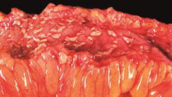 Pathology specimen of Crohn's disease (pictured) is a condition of inflammatory bowel disease (IBD)