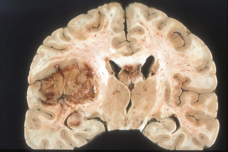 Researchers have induced a stronger immune response to dendritic cell therapy in patients with glioblastoma (pictured) using injections of tetanus and diphtheria toxins
