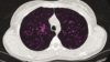 A combination therapy of two drugs that target the most common genetic mutation responsible for cystic fibrosis (CF) has been given a licence in the United States. In the image, a CT scan of a patient with cystic fibrosis (axial view)