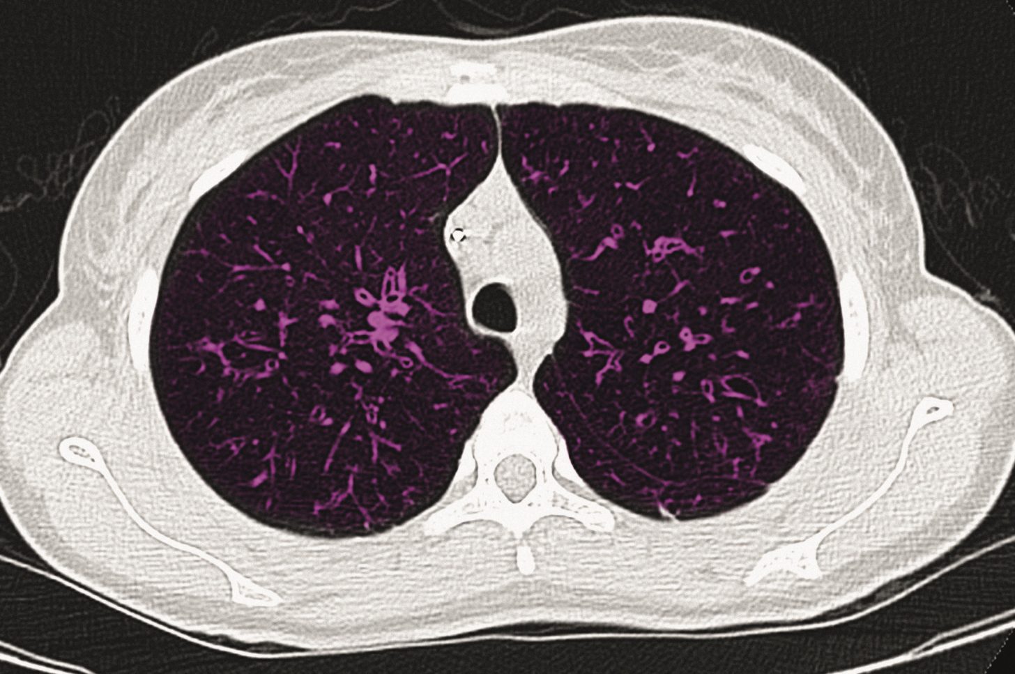 Cystic fibrosis therapy approved by US Food and Drug Administration ...