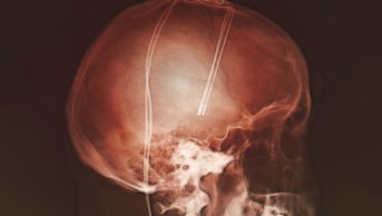 Researchers studied 42 Parkinson's disease patients who had electrodes implanted for deep brain stimulation treatment (x-ray pictured) and found that the initial administration of a placebo produced no response