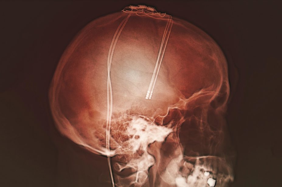 Researchers studied 42 Parkinson's disease patients who had electrodes implanted for deep brain stimulation treatment (x-ray pictured) and found that the initial administration of a placebo produced no response