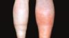 deep-vein-thrombosis-dvt-in-leg