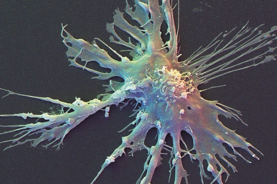 In a trial conducted at the University of Washington, researchers have created personalised vaccines for patients with advanced melanoma for the first time by incubating a sample of each patient’s dendritic cells (pictured) with the chosen set of antigens