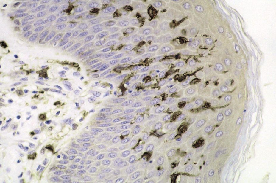 A single injection of a patient’s own modified dendritic cells (pictured) appears to safely deliver anti-inflammatory and immunoregulatory effects for rheumatoid arthritis (RA), a phase I study has shown.