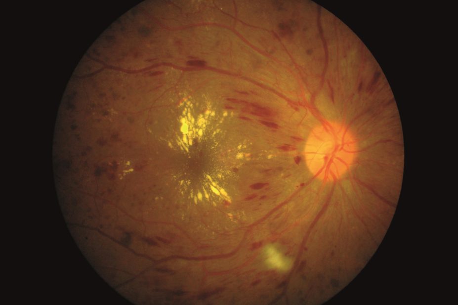 Treating diabetic retinopathy with ranibizumab is a reasonable alternative to laser treatment, study shows. In the image, retinal image of left eye