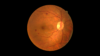 Photo of a person's eye displaying diabetic retinopathy
