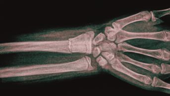 Middle-aged women who take antidepressant selective serotonin reuptake inhibitors (SSRIs) to treat menopausal symptoms may “significantly” increase their risk of bone fracture. In the image, film x-ray that show a distal radius fracture