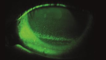 A typical dry eye. The green speckling shows the dry areas on the eye surface after instillation of a special eye drop