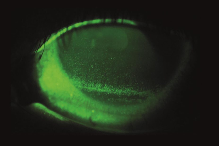 A typical dry eye. The green speckling shows the dry areas on the eye surface after instillation of a special eye drop