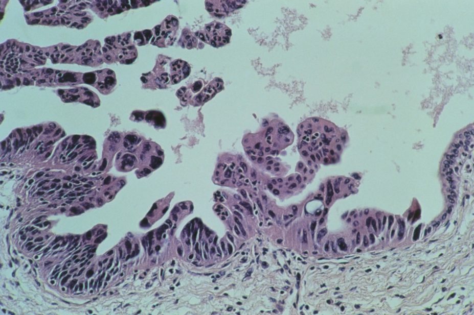 Light micrograph of ductal adenocarcinoma in human pancreas