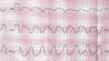 ECG tape showing paroxysmal ventricular tachycardia, a type of arrhythmia
