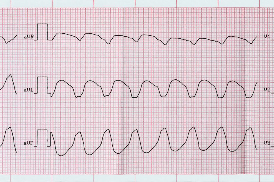 ECG tape showing paroxysmal ventricular tachycardia, a type of arrhythmia